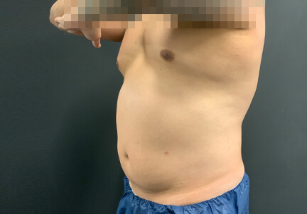 Gynecomastia 07