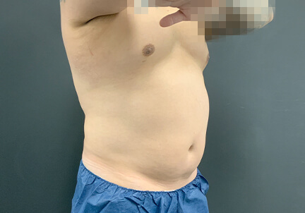 Gynecomastia 09