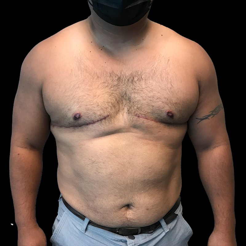 Gynecomastia 14