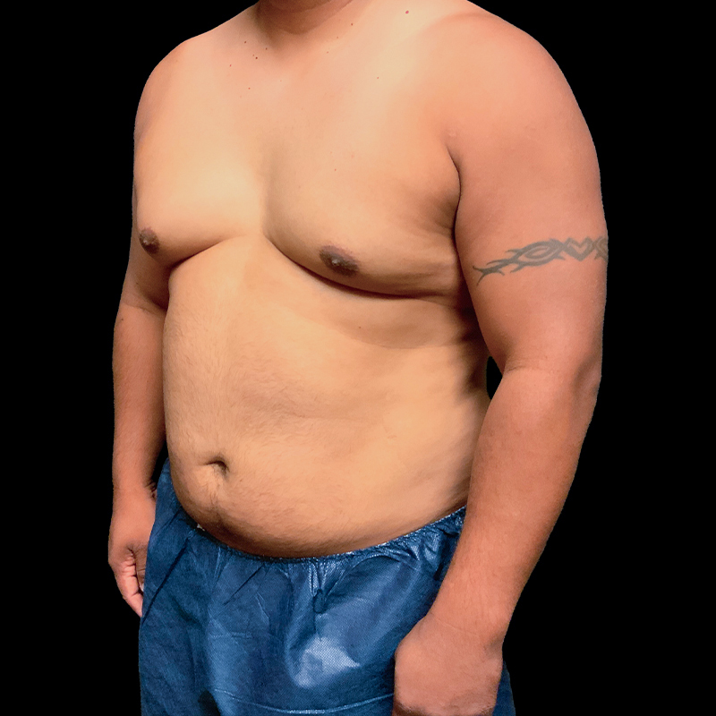 Gynecomastia 05