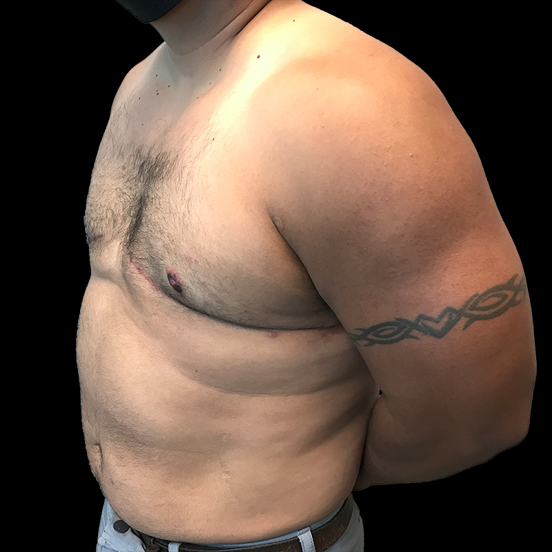 Gynecomastia 05