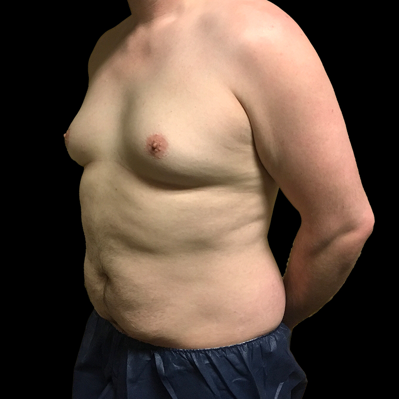 Gynecomastia 05