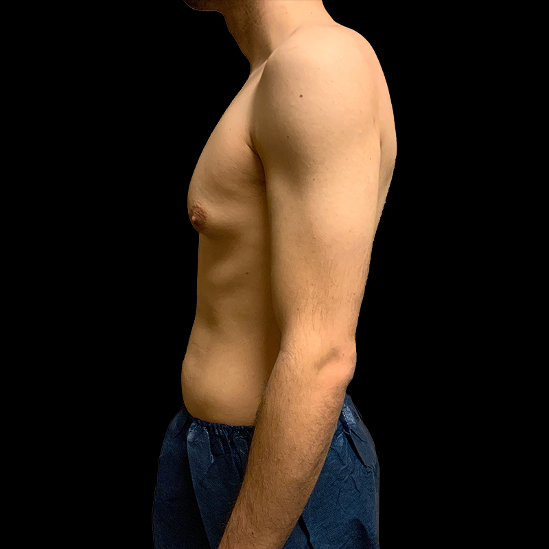 Gynecomastia 03