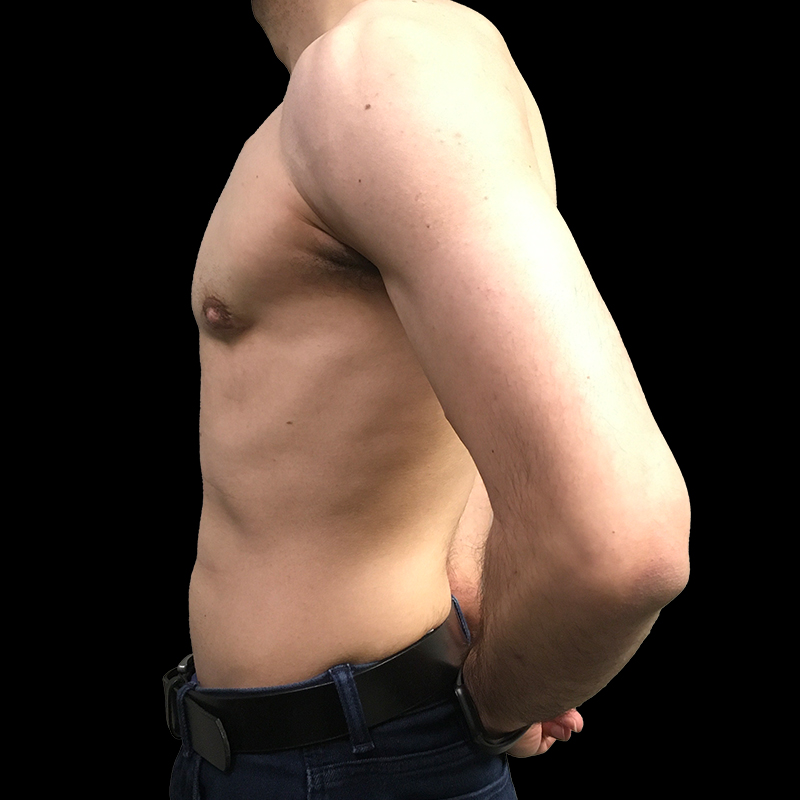 Gynecomastia 03