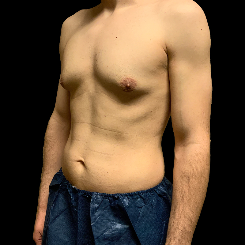 Gynecomastia 05