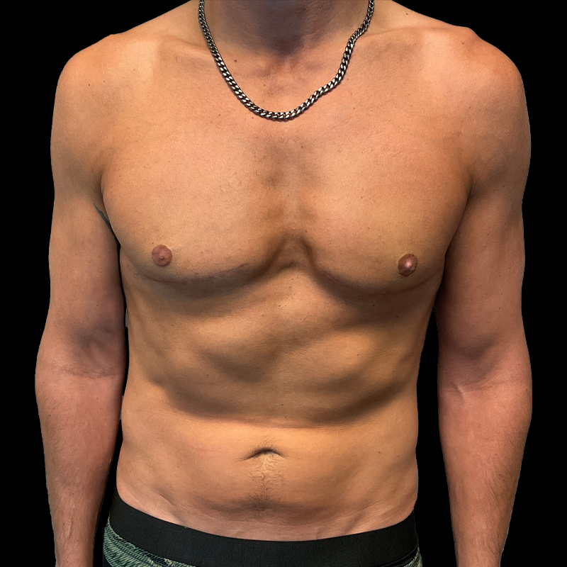 Gynecomastia 17