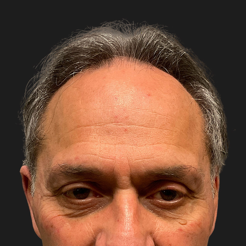 Hair Transplant 01
