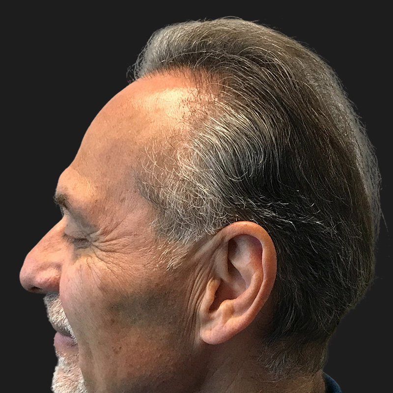Hair Transplant 05
