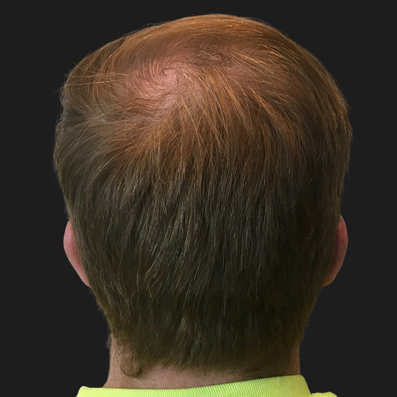 Hair Transplant 05