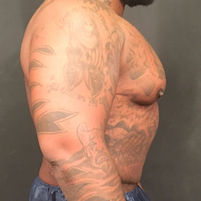 High Definition Liposuction 05