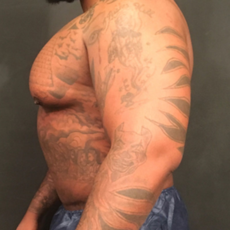 High Definition Liposuction 07