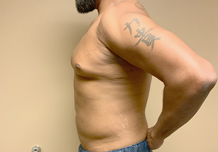 High Definition Liposuction 01