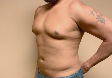 High Definition Liposuction 03