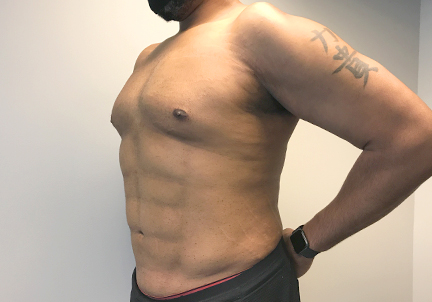 High Definition Liposuction 03