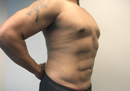 High Definition Liposuction 07