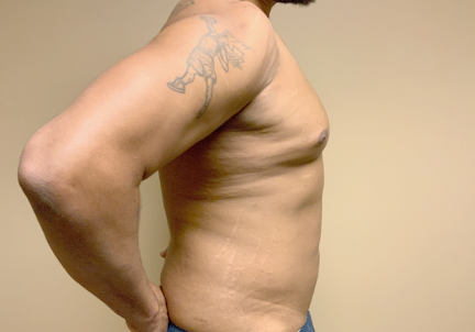 High Definition Liposuction 09