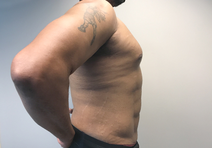 High Definition Liposuction 09