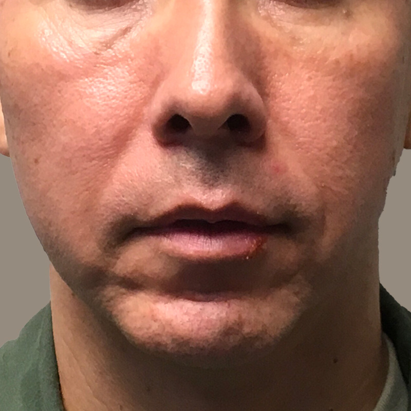 Injectables And Fillers 01