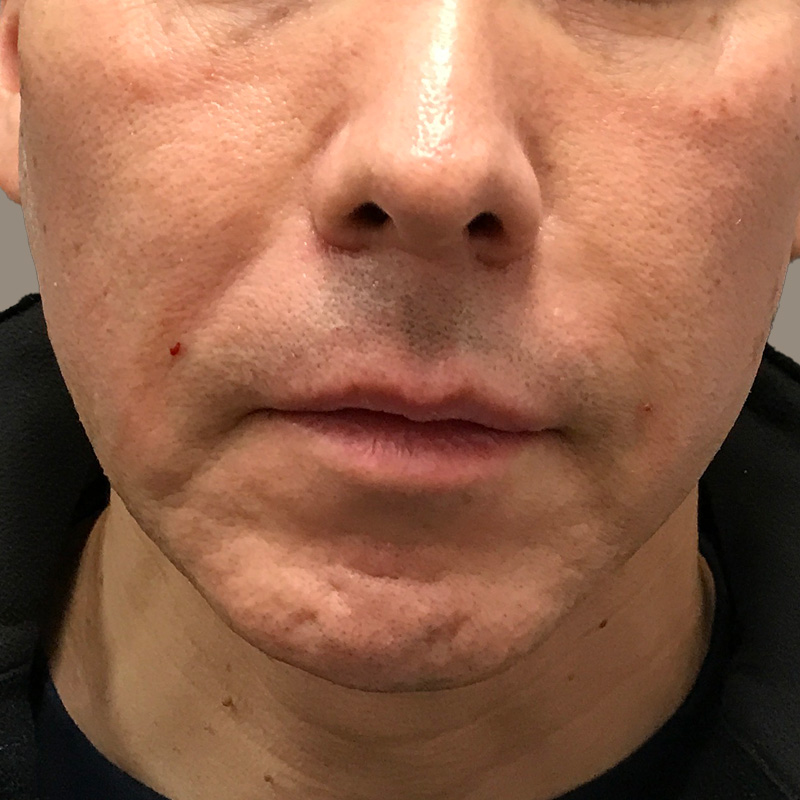 Injectables And Fillers 01