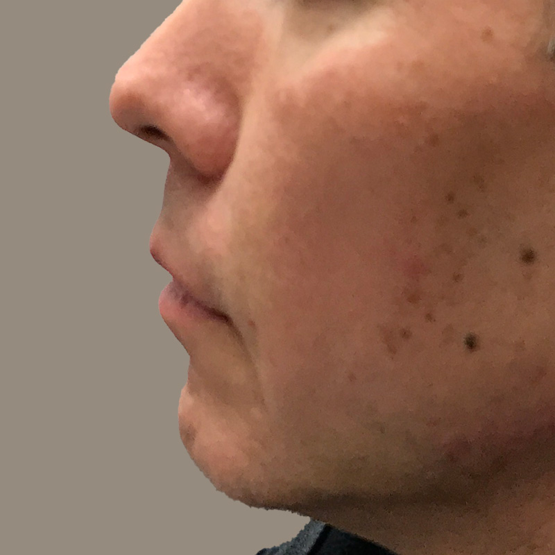 Injectables And Fillers 05