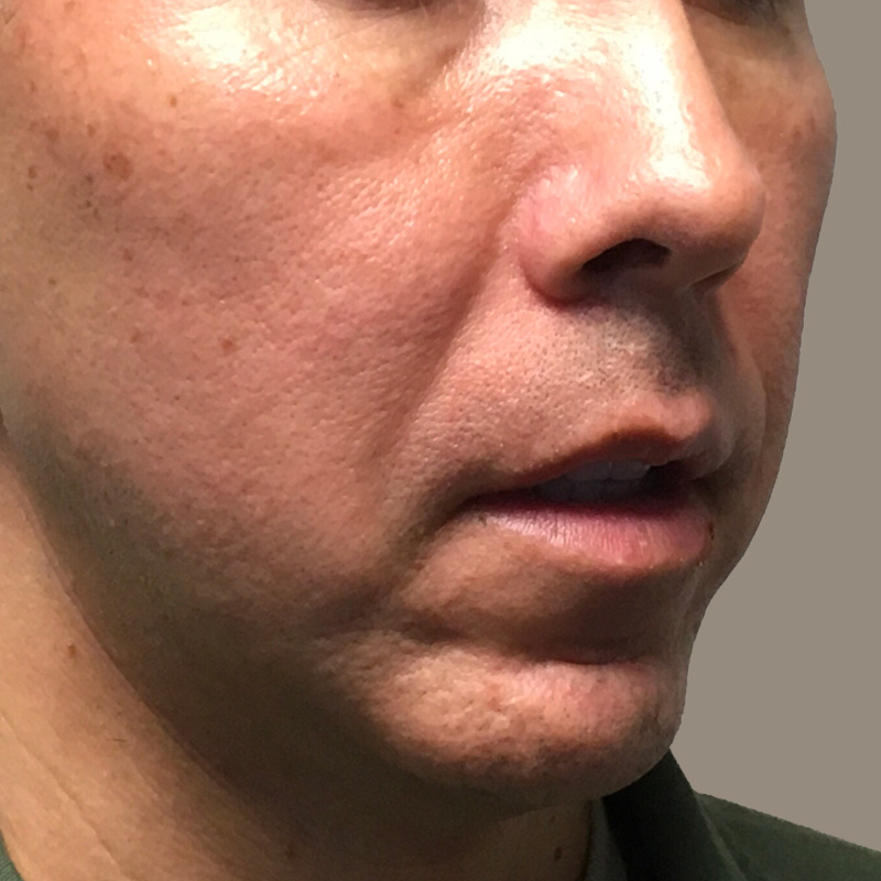 Injectables And Fillers 07