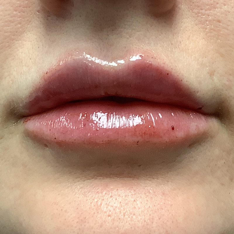 Injectables And Fillers 03