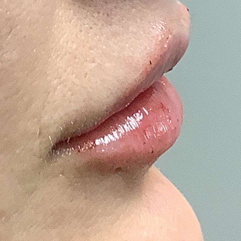 Injectables And Fillers 03