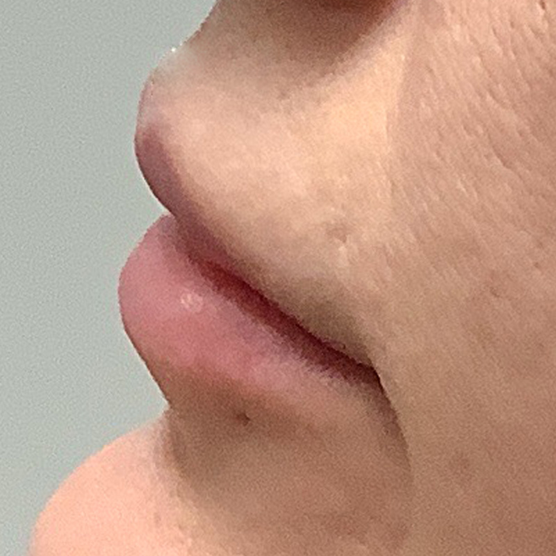 Injectables And Fillers 05