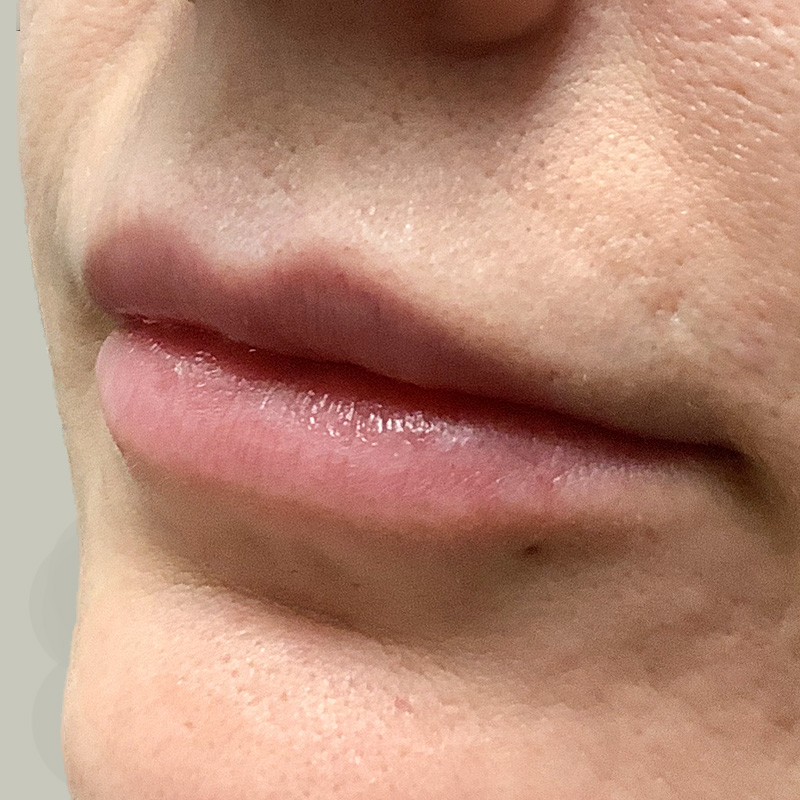 Injectables And Fillers 07