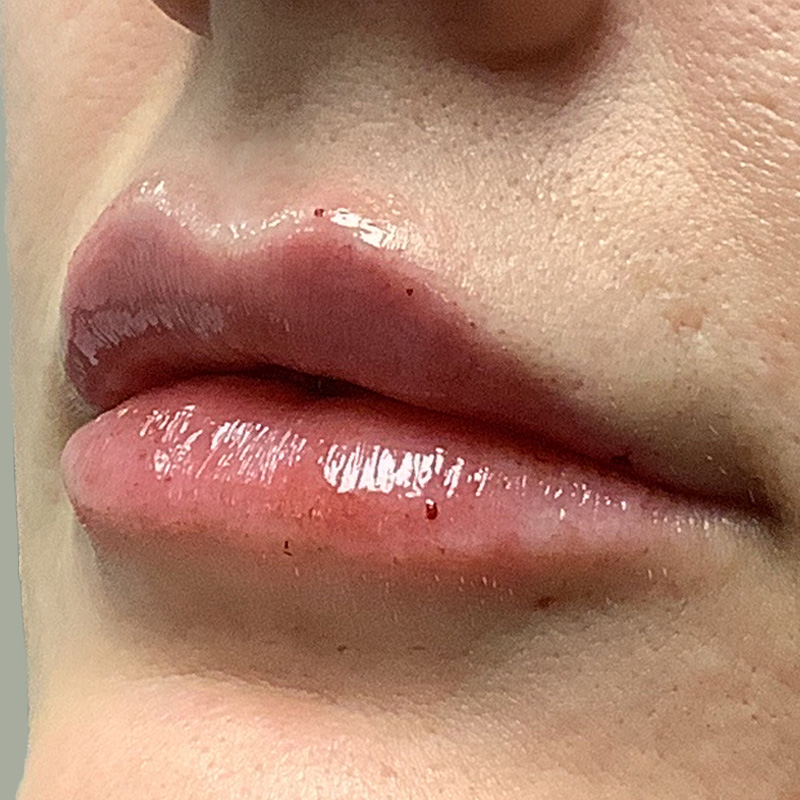 Injectables And Fillers 07