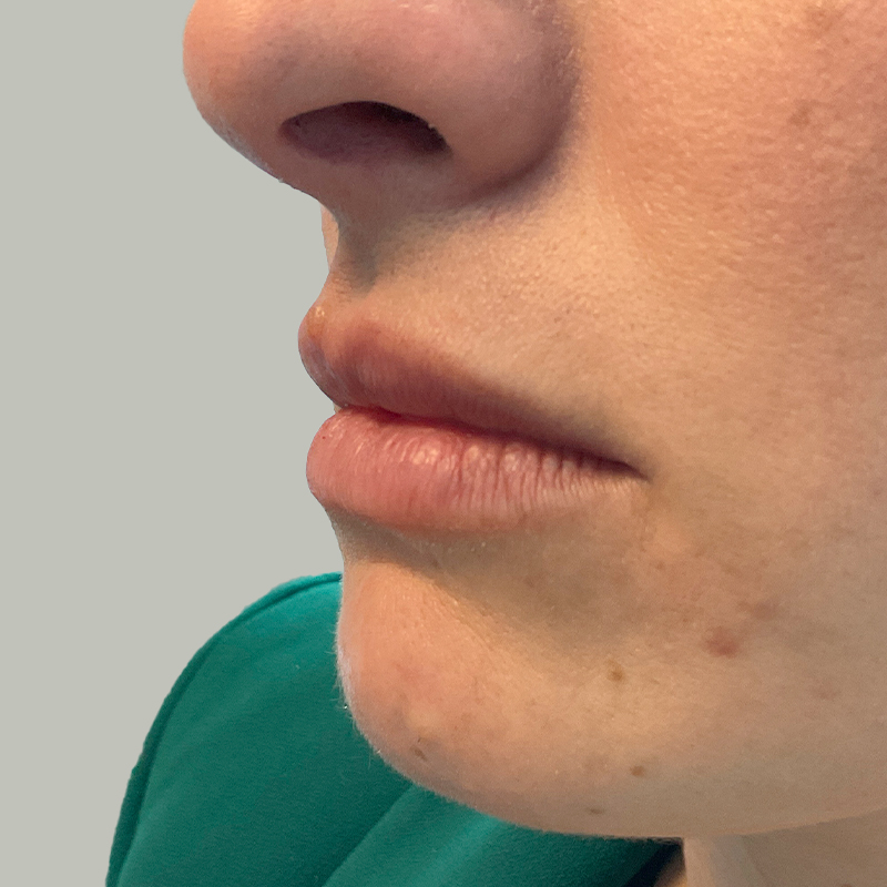 Injectables And Fillers 03