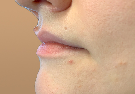 Injectables And Fillers 05