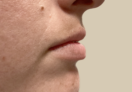 Injectables And Fillers 09