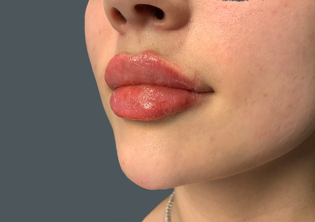 Injectables And Fillers 03