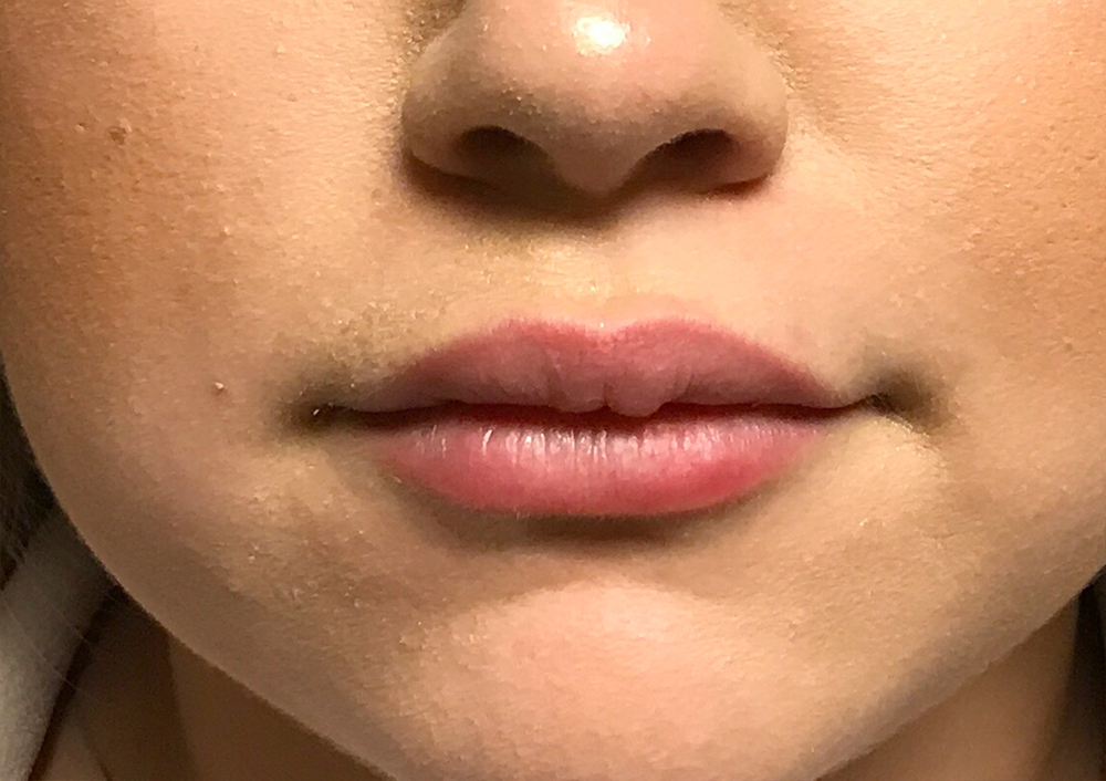 Injectables And Fillers 01