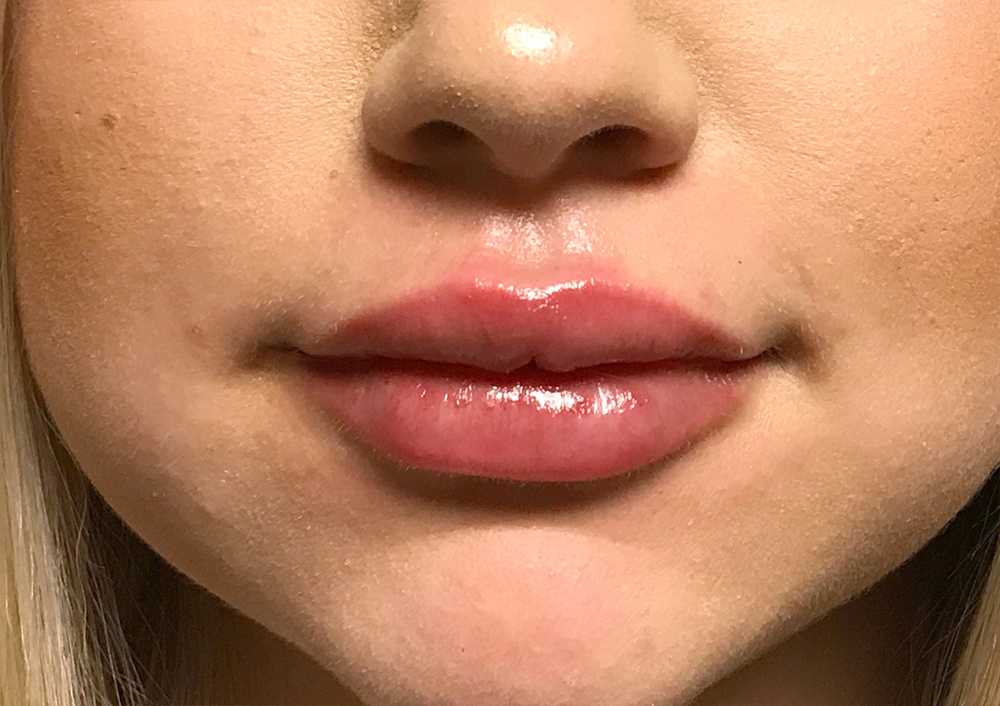 Injectables And Fillers 100