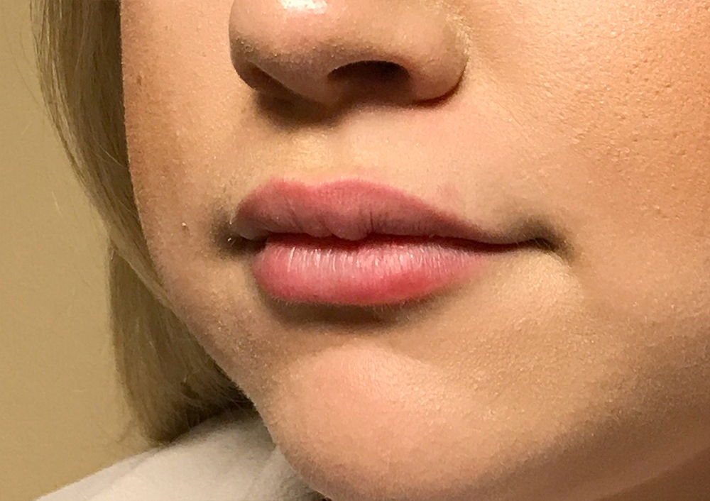 Injectables And Fillers 03