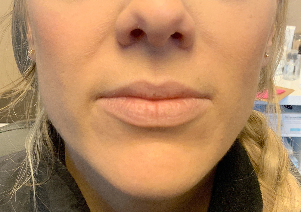 Injectables And Fillers 01