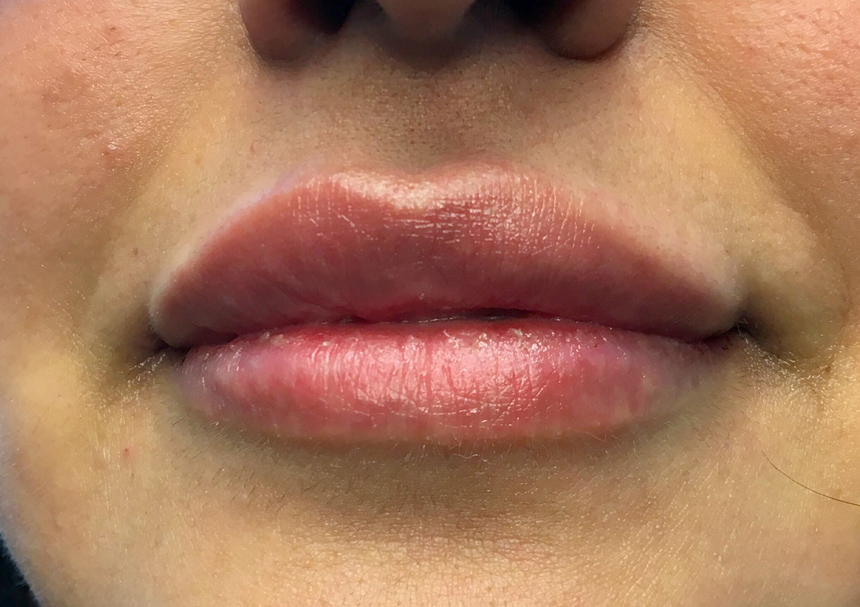 Injectables And Fillers 102