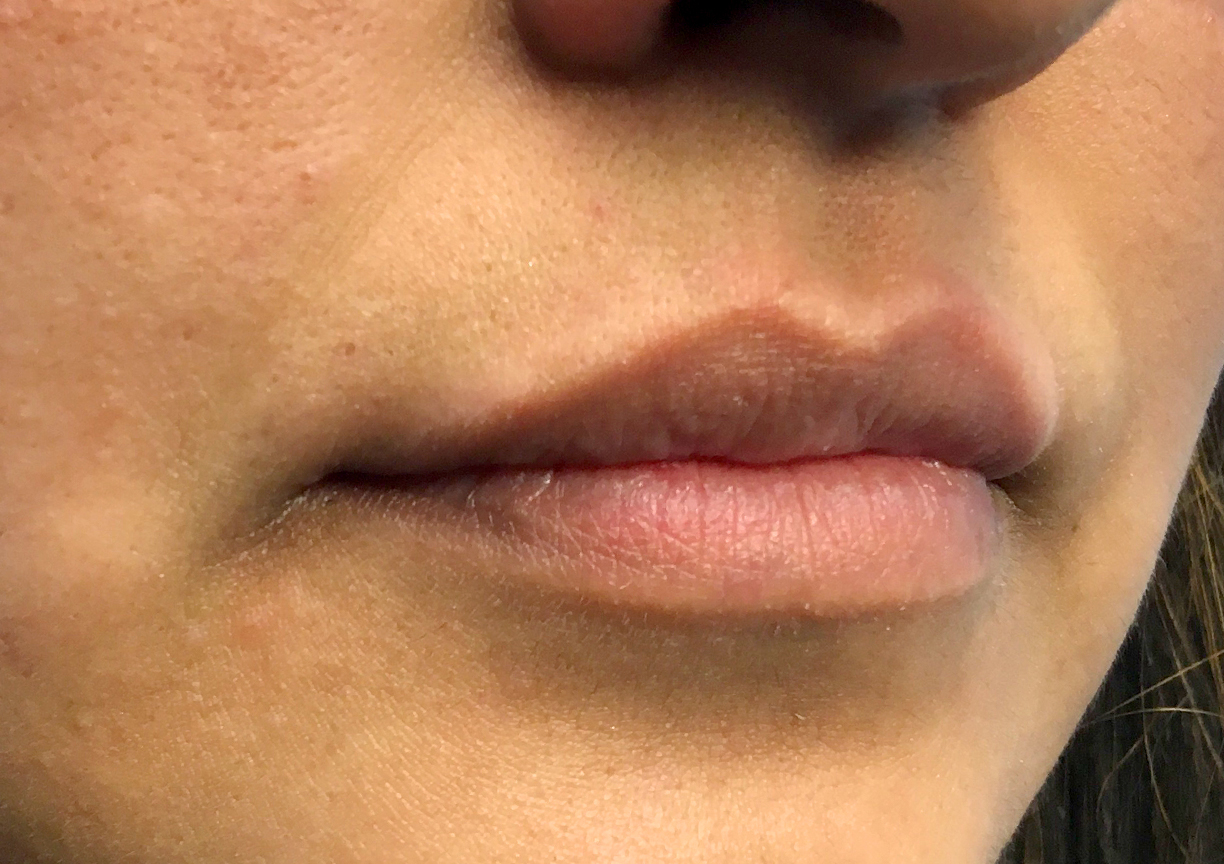 Injectables And Fillers 03