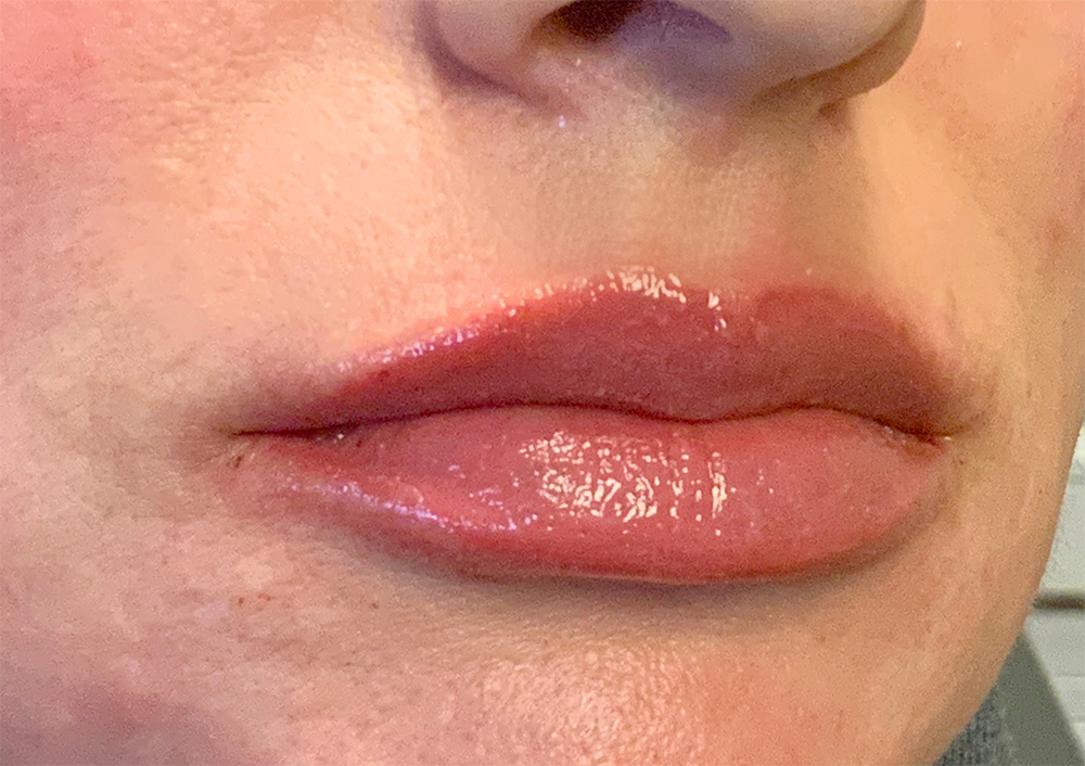 Injectables And Fillers 03