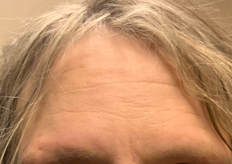 Injectables And Fillers 104