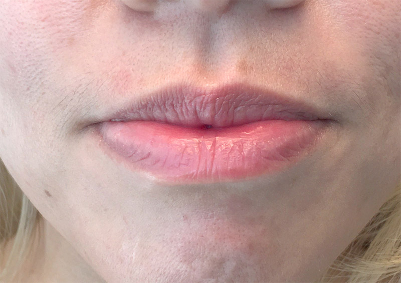 Injectables And Fillers 01