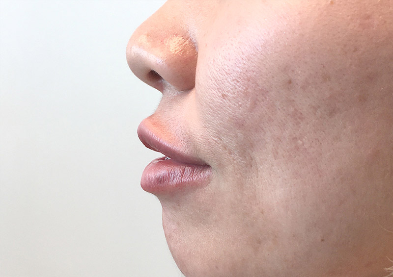 Injectables And Fillers 03