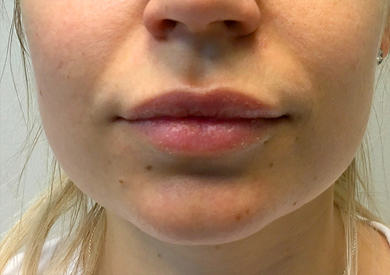 Injectables And Fillers 106