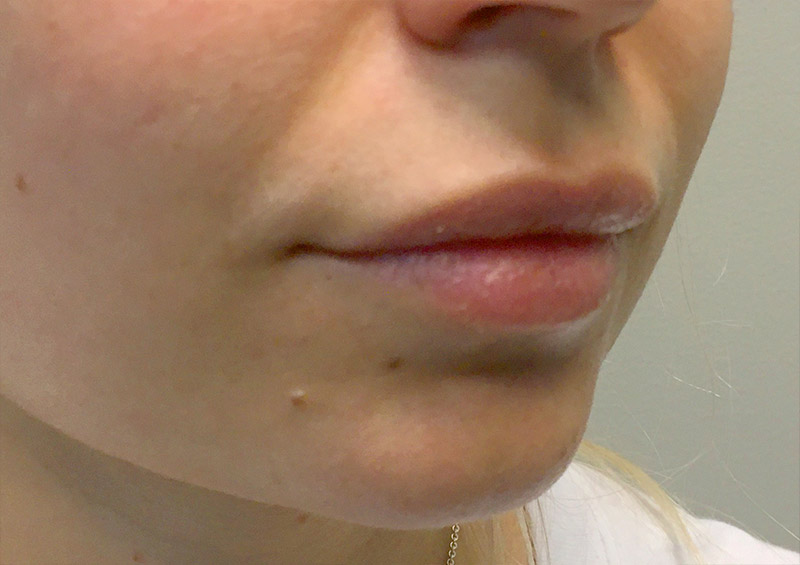 Injectables And Fillers 03