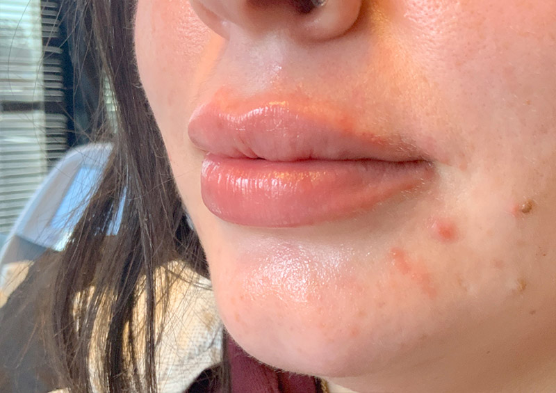 Injectables And Fillers 03