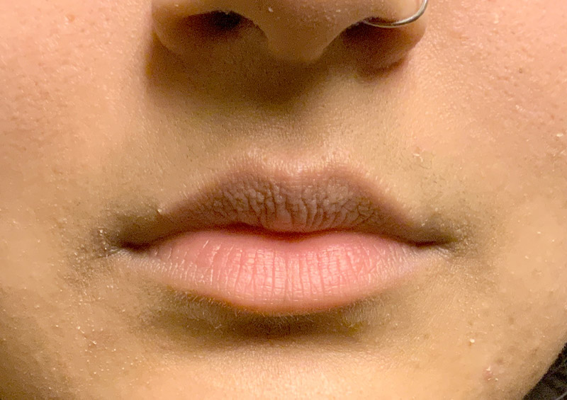 Injectables And Fillers 01