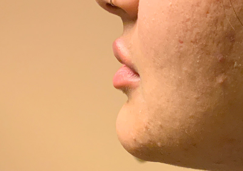 Injectables And Fillers 03