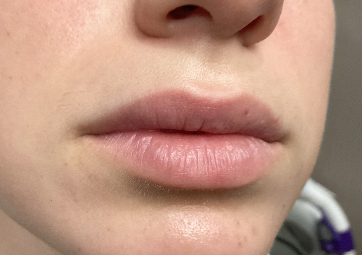 Injectables And Fillers 03